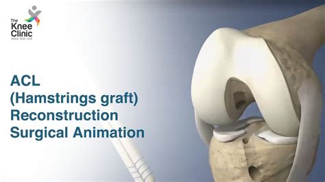 Acl reconstruction hamstring graft animation